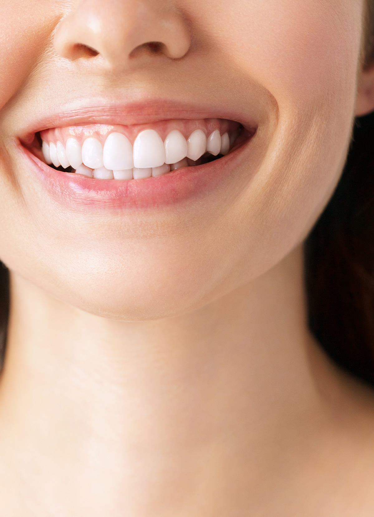 Dental Veneers at NIS Dental Image, Patong Phuket