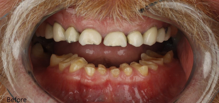 Full-Mouth Rehabilitation at NIS Dental Image, Patong Phuket